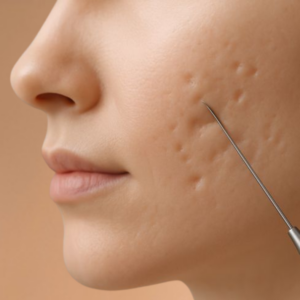 Acne Scar Subcision