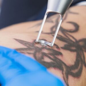Tattoo Removal